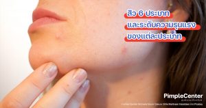 ประเภทสิว ชนิดของ สิว แต่ละประเภท ประเภทของสิว มีกี่ชนิด