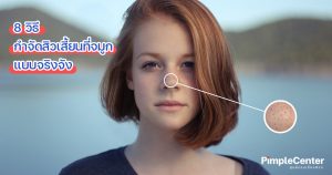 สิวเสี้ยนเยอะตรงจมูก วิธีกําจัด สิวเสี้ยนที่จมูก Pimple Clinic