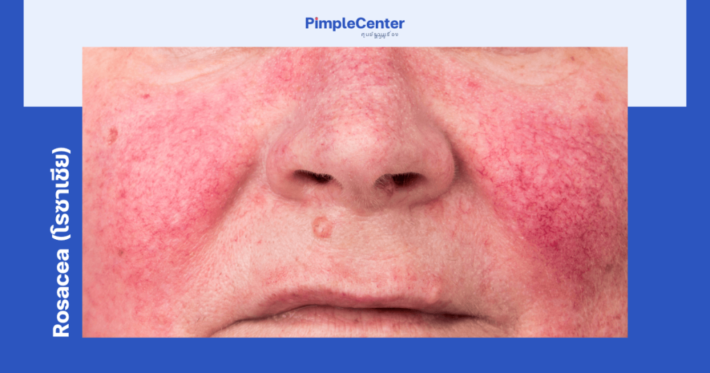 อาการ acne rosacea ผื่นแดงบนหน้า