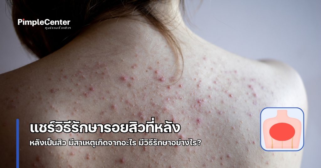 รอยสิวที่หลัง