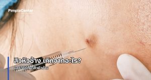 สิวหัวช้าง เกิดจากอะไร