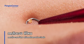 กดสิว