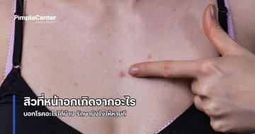 สิวที่หน้าอก