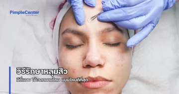 วิธีรักษาหลุมสิว