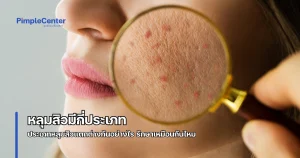 ประเภทหลุมสิว