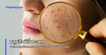 ประเภทหลุมสิว
