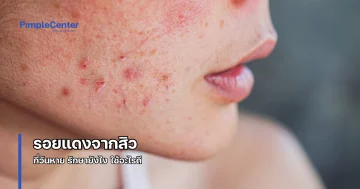 รอยแดงจากสิว